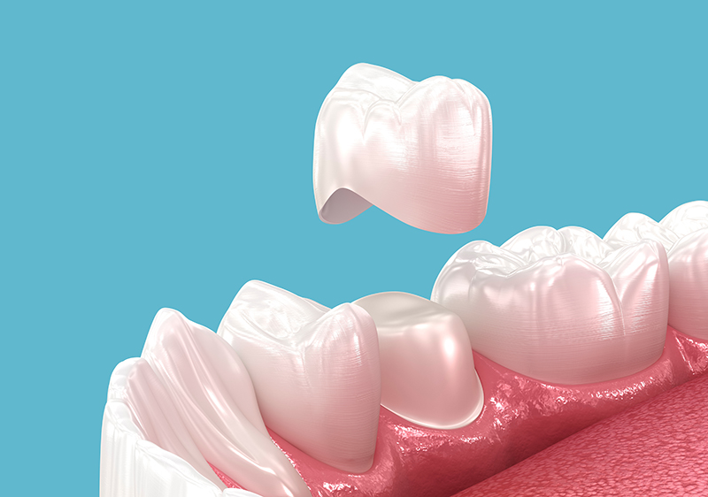 Dental,Crown,Placement,Over,Tooth.,3d,Illustration