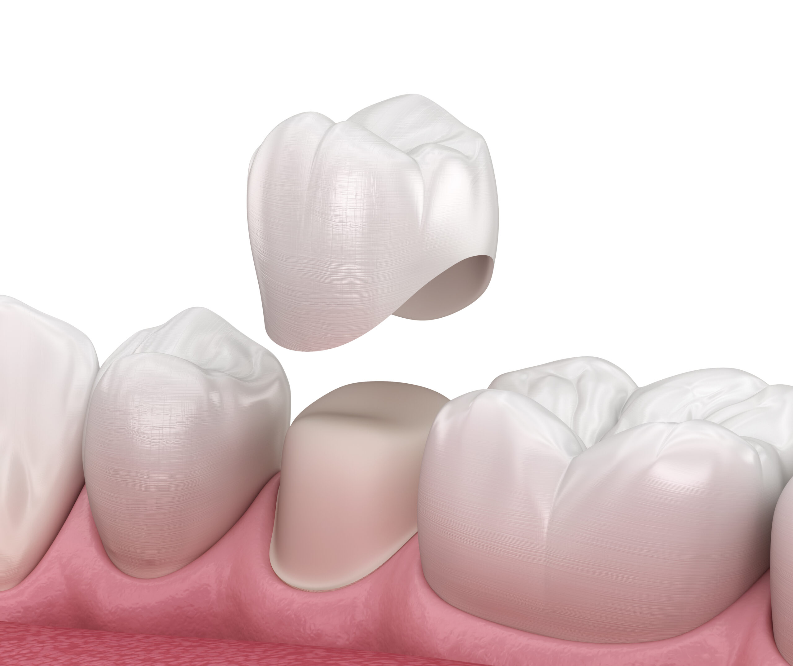 Preparated,Premolar,Tooth,And,Dental,Crown,Placement.,Medically,Accurate,3d