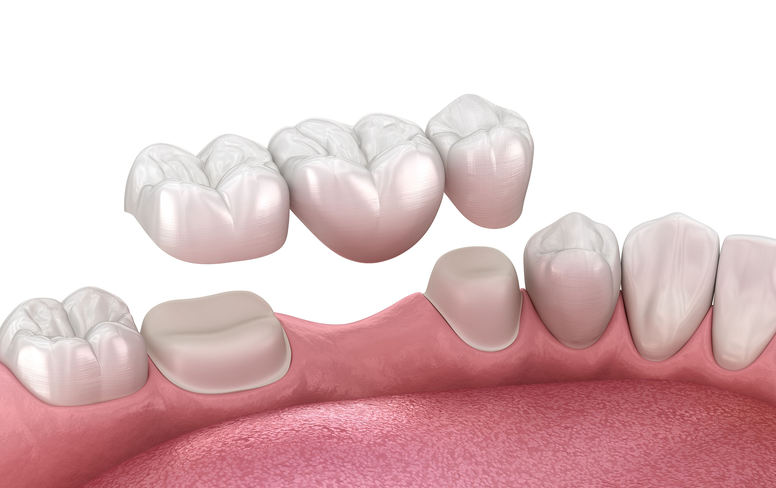 Dental,Bridge,Based,On,2,Teeth.,3d,Illustration