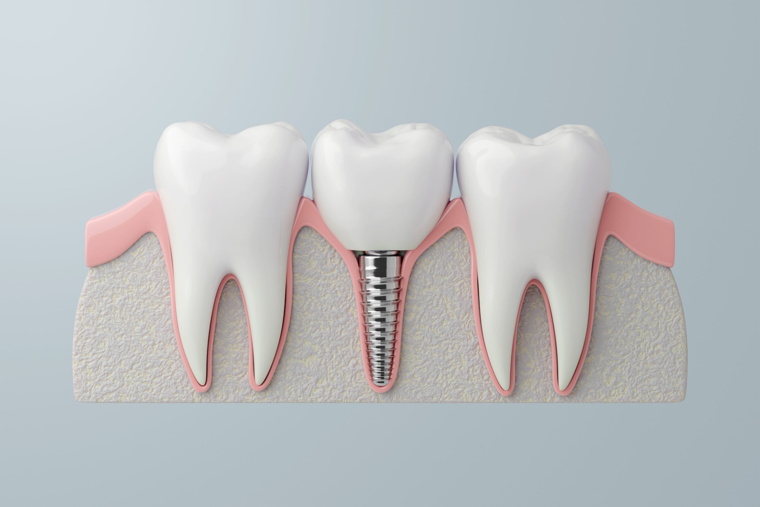 Single,Dental,Implant,Titanium,Material.,3d,Rendering.