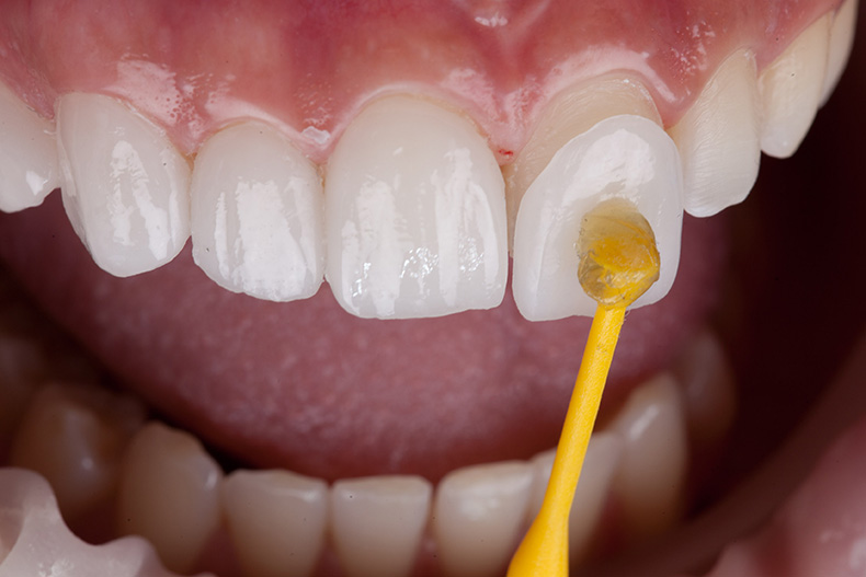 Dental,,Smile,Design,,White,Teeth