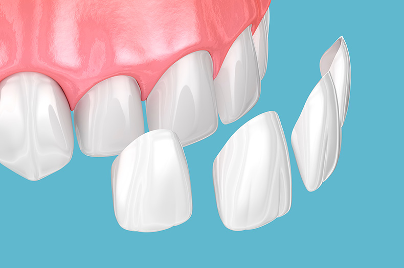 Dental,Veneer,Placement,Over,Frontal,Teeth.,3d,Illustration